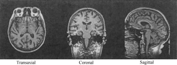 Fig 1. MRI section of a human head